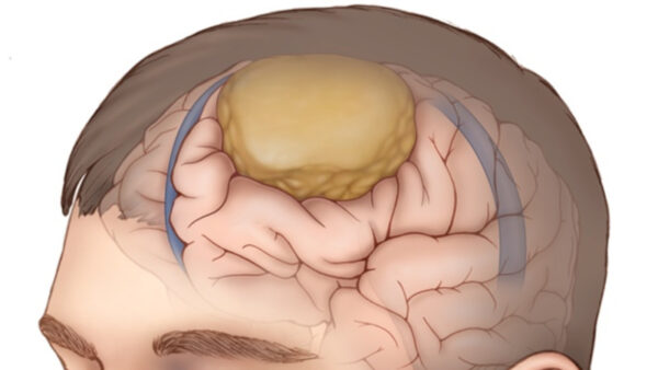 Meningioma Brain Tumor